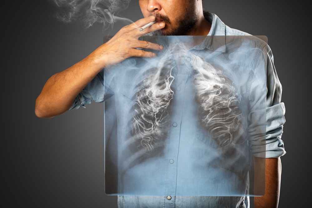 Αιτίες και παράγοντες κινδύνου για τον καρκίνο του πνεύμονα