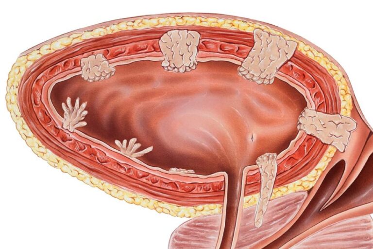 Καρκίνος της ουροδόχου κύστης. Τι ακριβώς είναι και ποια είναι τα ποσοστά επιβίωσης και το προσδόκιμο ζωής