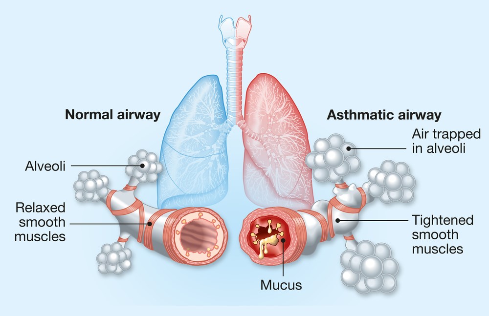 Τι συμβαίνει στο σώμα μας όταν έχουμε άσθμα;